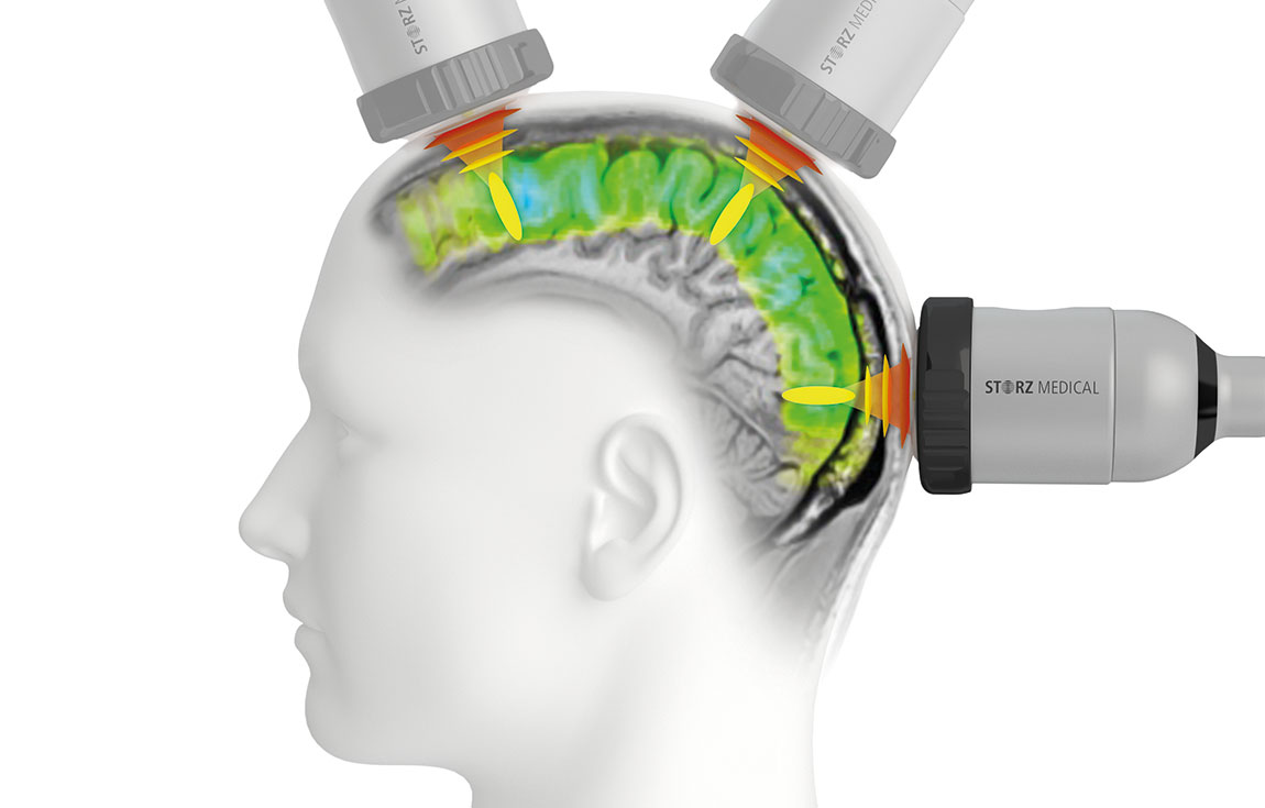 Alzheimer nicaragua